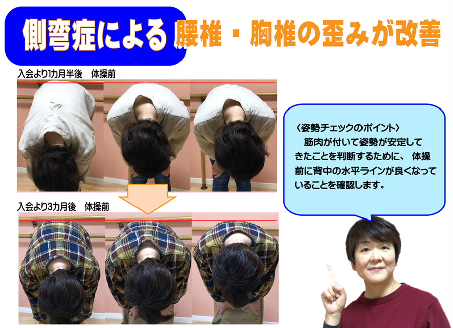 側弯症の脊柱の歪みで腰椎と胸椎でコブが目立っていたのがなおって、姿勢矯正で歩き方も改善した