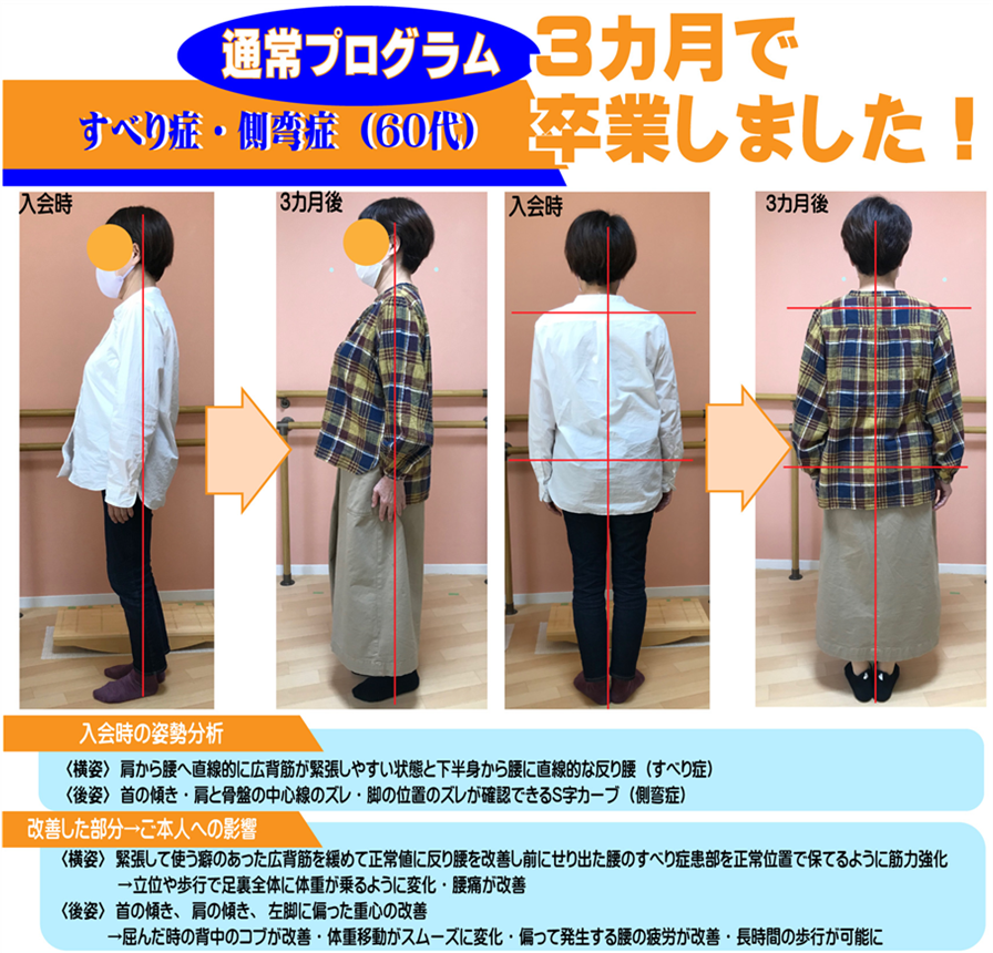 すべり症の腰痛と側弯症もあったが、骨格の歪みを整え体軸を強化し、短期間で姿勢矯正と歩き方矯正に成功