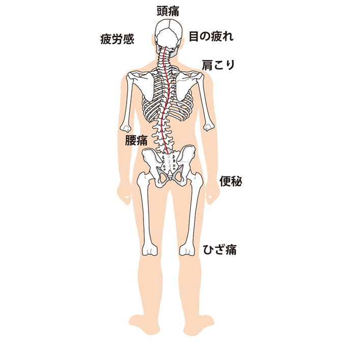 側弯症の症状は、頭痛、疲労感、肩凝り、腰痛、便秘、膝痛など全身に現れる