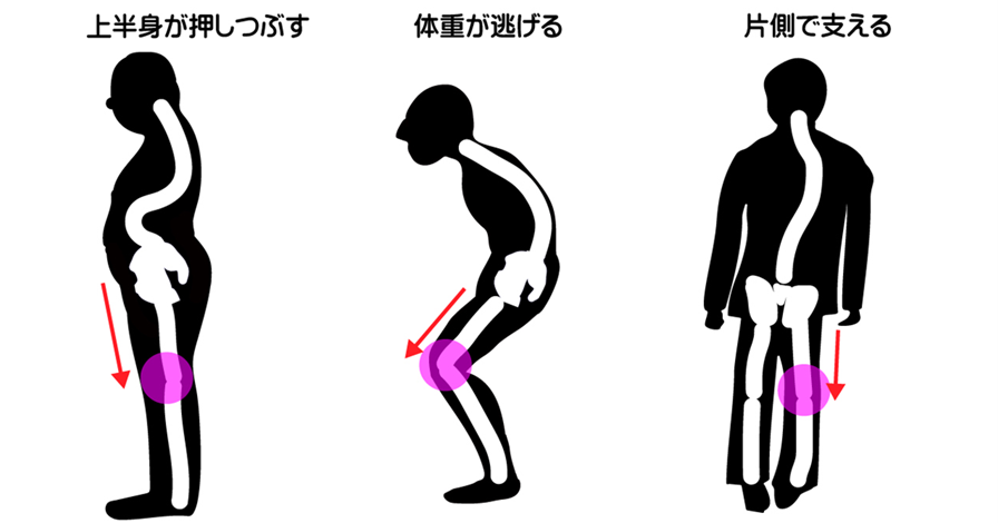 膝関節を潰す姿勢は、上半身で押しつぶす、体重が逃げる、片膝で支える姿勢があり、姿勢矯正は必要