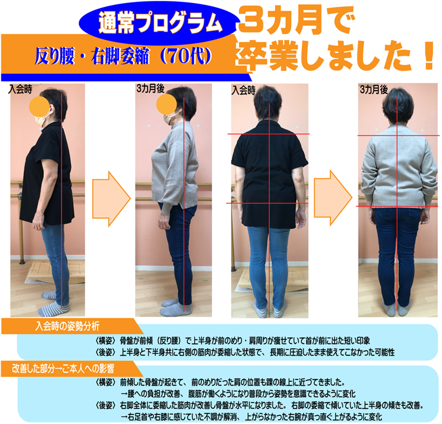 右足に重心が偏った側弯症で、踵や膝や股関節の痛みを感じる脚長差を、対称に姿勢矯正