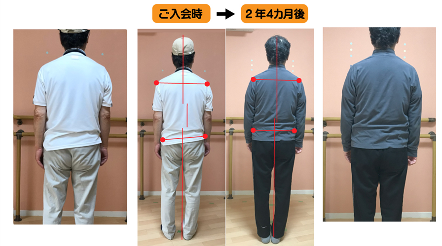 骨盤の歪みと脚長差があり、背骨の捻じれと弯曲で固まった背中の柔軟性を側弯症トレーニングで改善した例