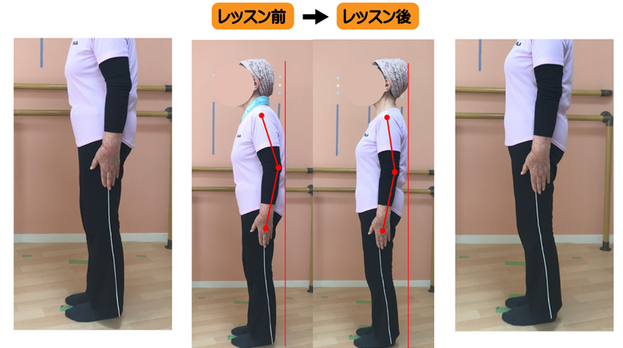 円背で膝が前に出てO脚で脚長差が強かったが、背骨を動きと脚長差を側弯トレーニングで改善した例