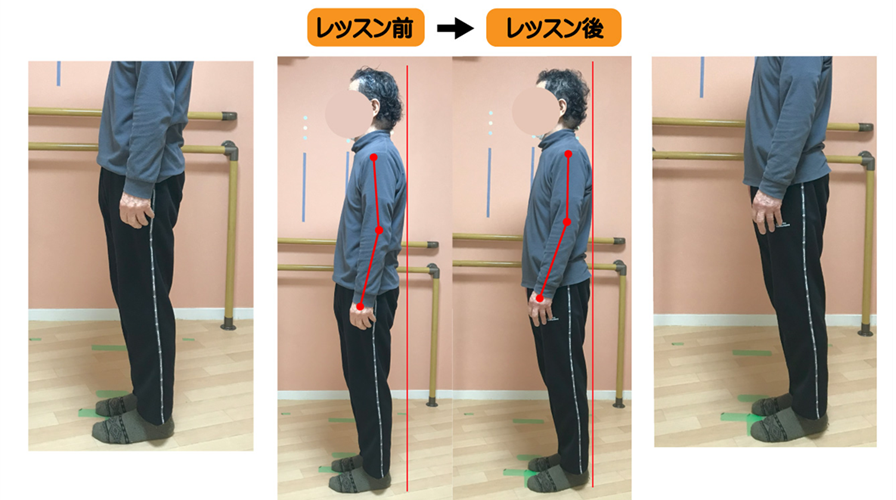 平背とポッコリお腹と下肢筋肉の短縮を、アナトミートレイントレーニングで姿勢改善に成功した例